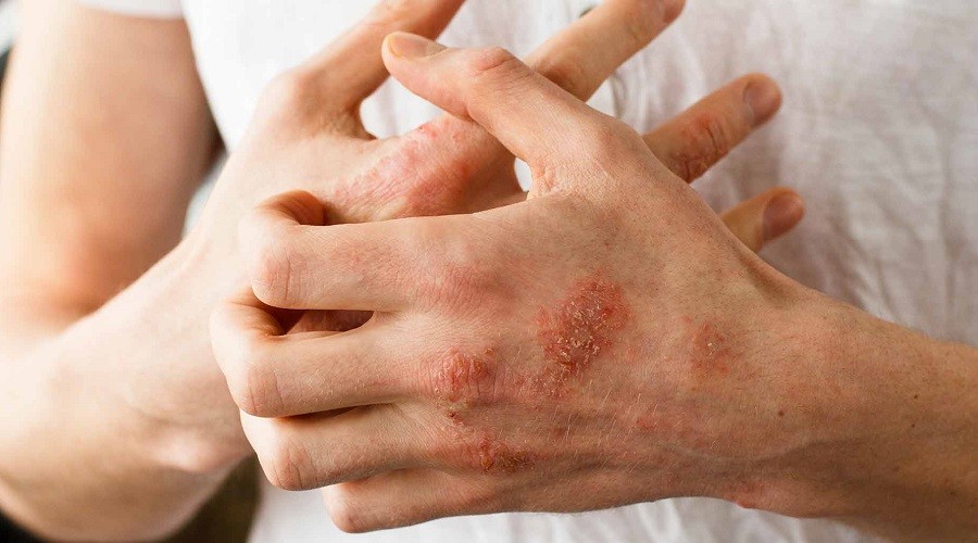 Psoriasis