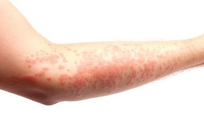 Sintomas de la psoriasis