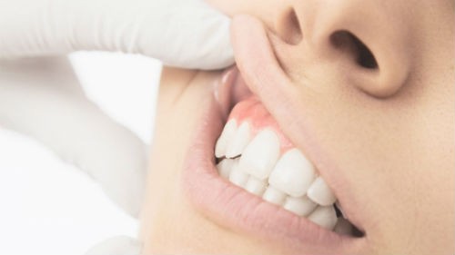 consejos gingivitis