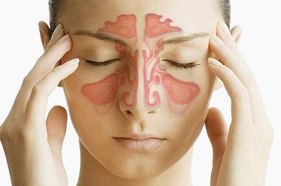 Que es la sinusitis