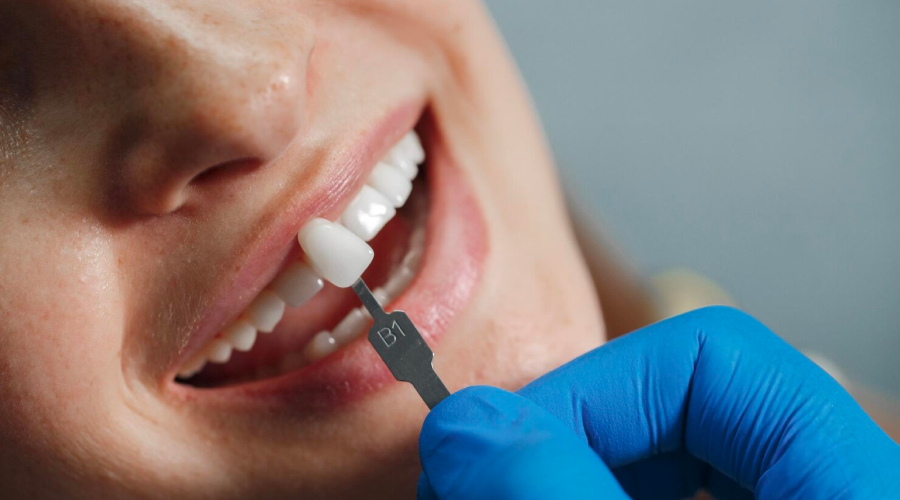 Implantes dentales